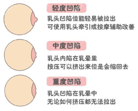 女生奶頭有毛|乳頭內凹、長毛正常嗎？ 8類「乳頭形狀」你的是哪種 